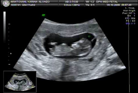 Foto de uma ultrassom morfológico de 11 semanas
