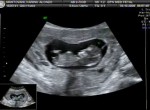 Foto de uma ultrassom morfológico
