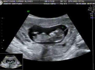 Foto de uma ultrassom morfológico